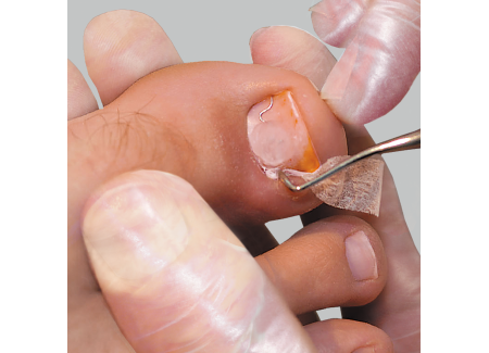 Nail edge tamponade